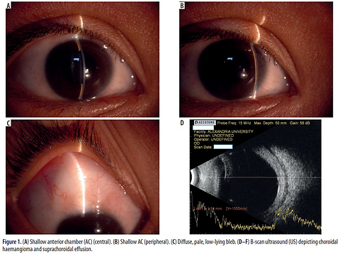 Delayed suprachoroidal effusion in Sturge-Weber syndrome
